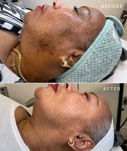 PicoWay Resolve Laser - Result 3