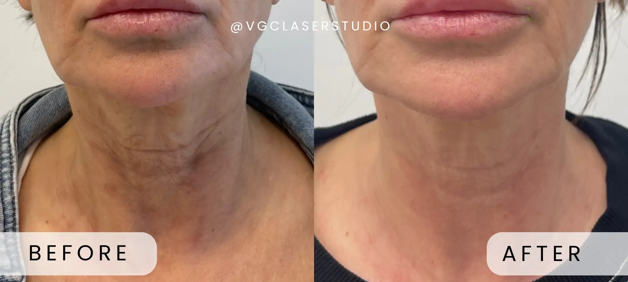 Fotona laser before and after - client 1