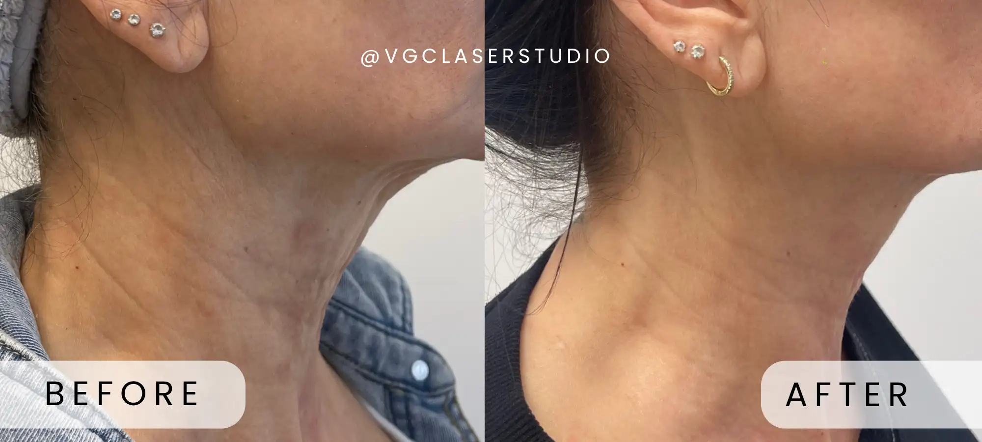 Fotona laser before and after - client 2