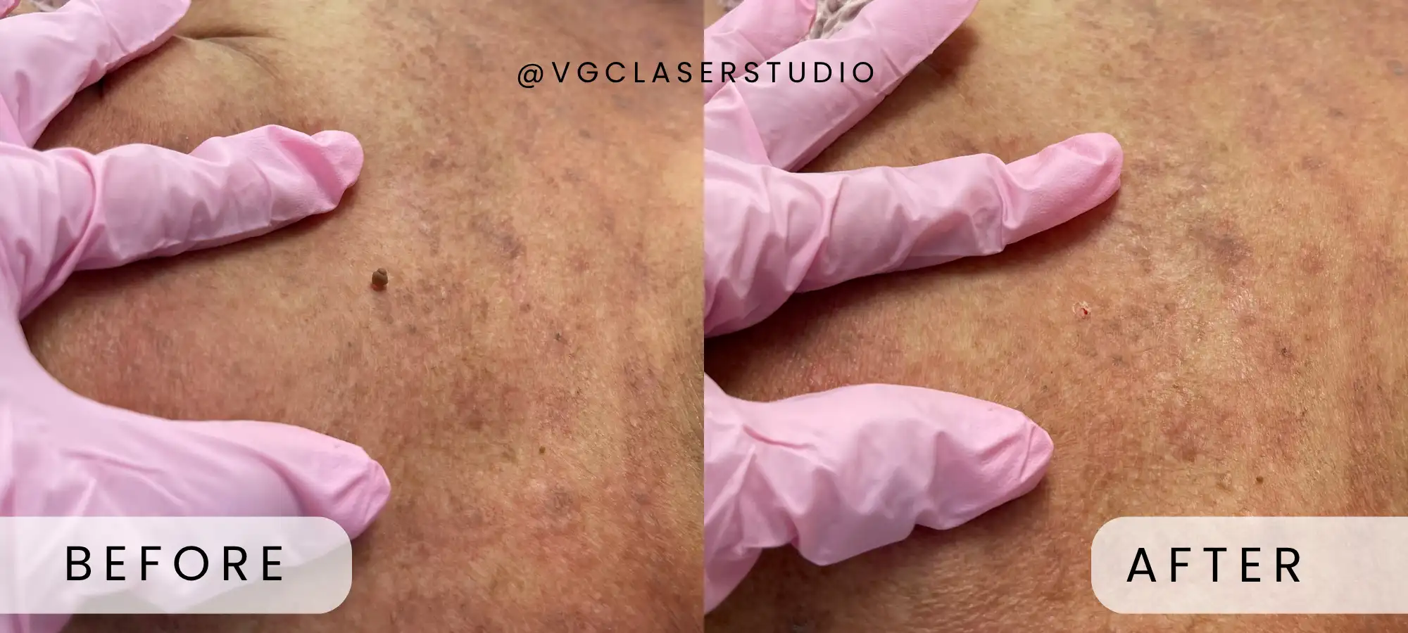 Fotona laser before and after - client 3