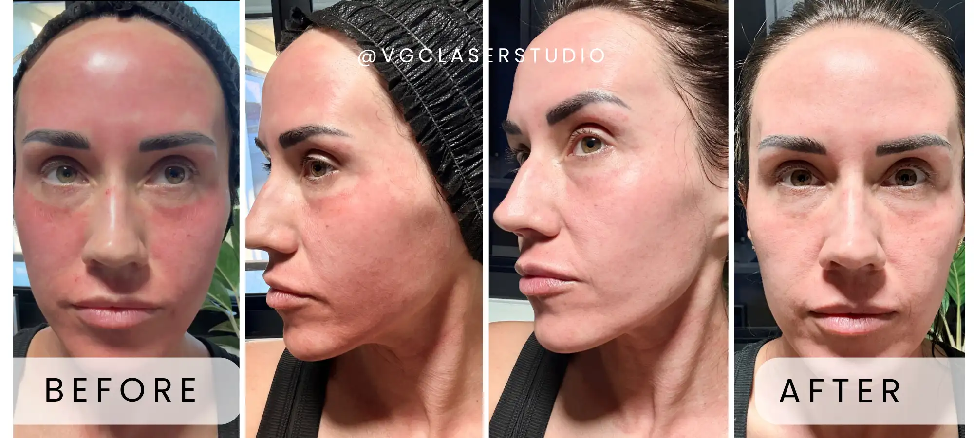 CO2 Lift Pro & Microneedling before and after - client 1