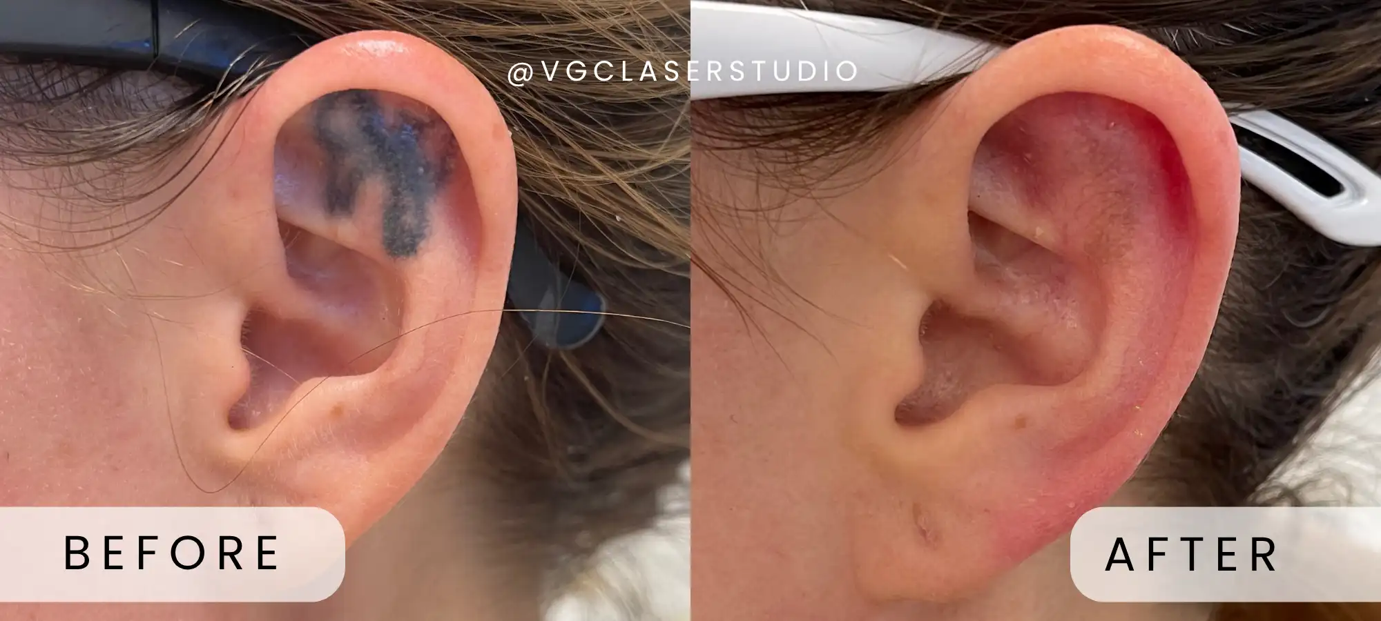 PicoWay laser tattoo removal before and after - client 1