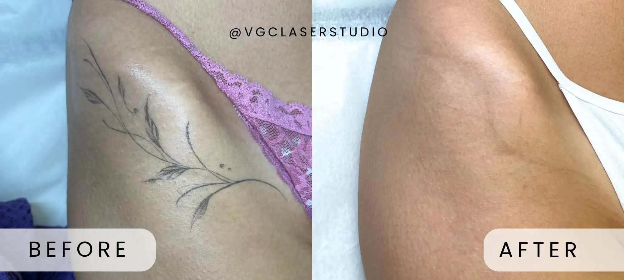 PicoWay laser tattoo removal before and after - client 2