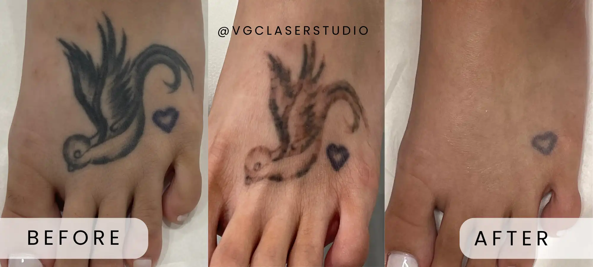 PicoWay laser tattoo removal before and after - client 3